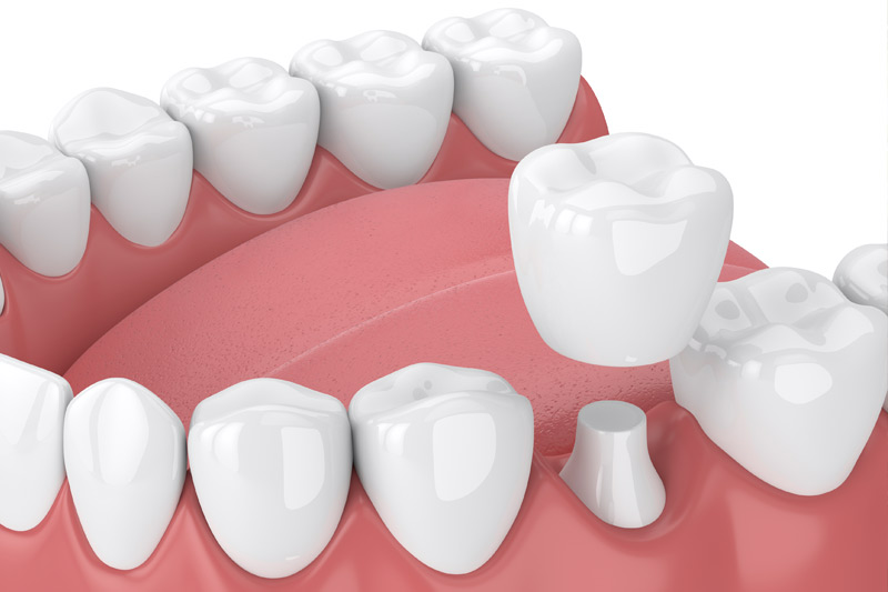 Dental Crowns in Manchester