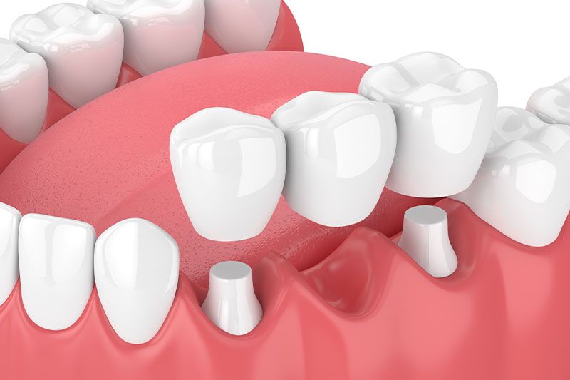 Dental Bridges in Manchester