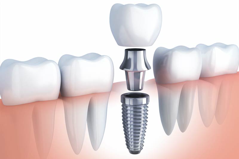 Dental Implants in Manchester