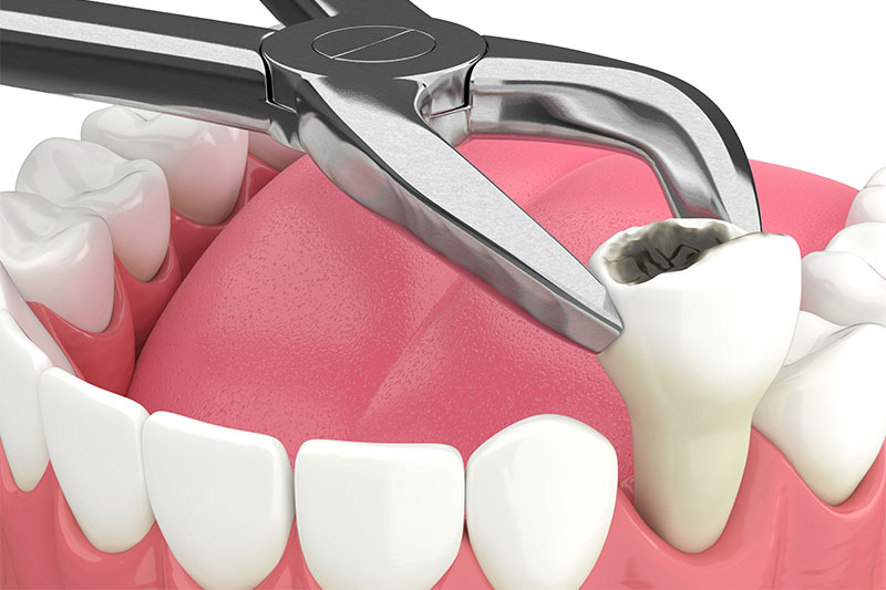 Tooth Extraction in Manchester